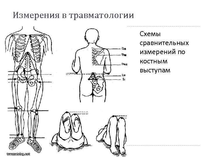 Измерения в травматологии Схемы сравнительных измерений по костным выступам 