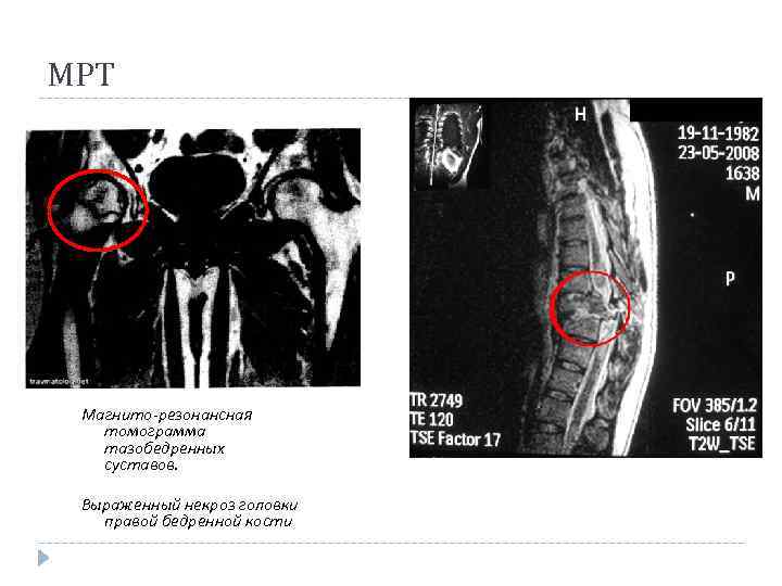 МРТ Магнито-резонансная томограмма тазобедренных суставов. Выраженный некроз головки правой бедренной кости 