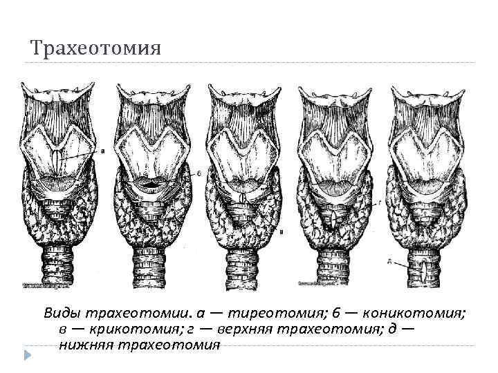Трахеотомия Виды трахеотомии. а — тиреотомия; 6 — коникотомия; в — крикотомия; г —