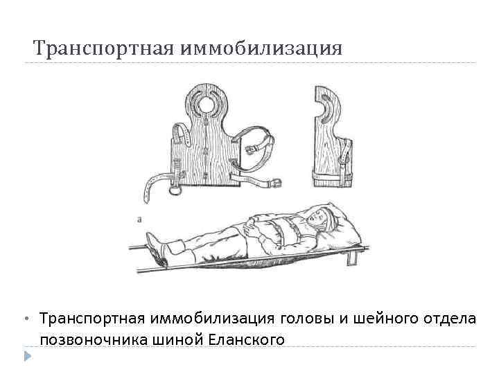 Транспортная иммобилизация • Транспортная иммобилизация головы и шейного отдела позвоночника шиной Еланского 