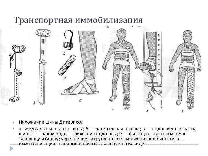 Транспортная иммобилизация • • Наложение шины Дитерихса а медиальная планка шины; б — латеральная