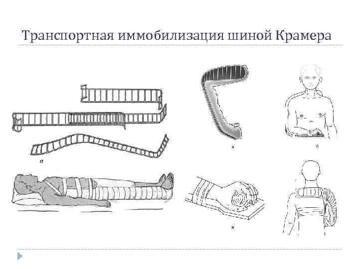 Транспортная иммобилизация шиной Крамера 