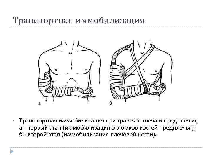Транспортная иммобилизация • Транспортная иммобилизация при травмах плеча и предплечья, а первый этап (иммобилизация