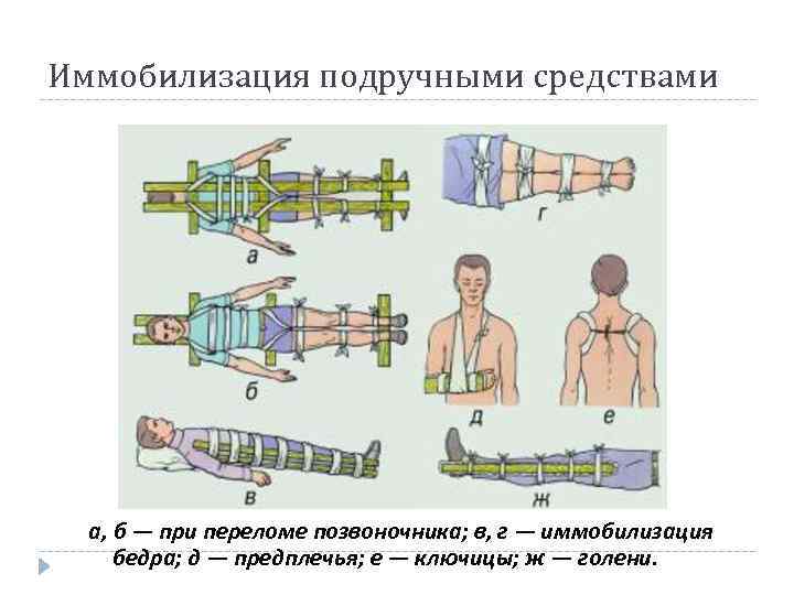 Иммобилизация подручными средствами а, б — при переломе позвоночника; в, г — иммобилизация бедра;