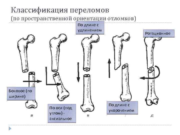 Классификация переломов (по пространственной ориентации отломков) По длине с удлинением Ротационное Боковое (по ширине)