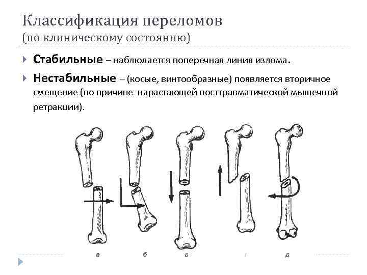 Классификация переломов и вывихов. Классификация переломов по линии излома. Поперечные косые винтообразные переломы. Классификация переломов по причине.