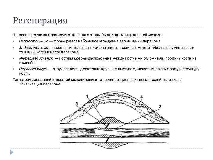 Регенерация На месте перелома формируется костная мозоль. Выделяют 4 вида костной мозоли: Периостальную —