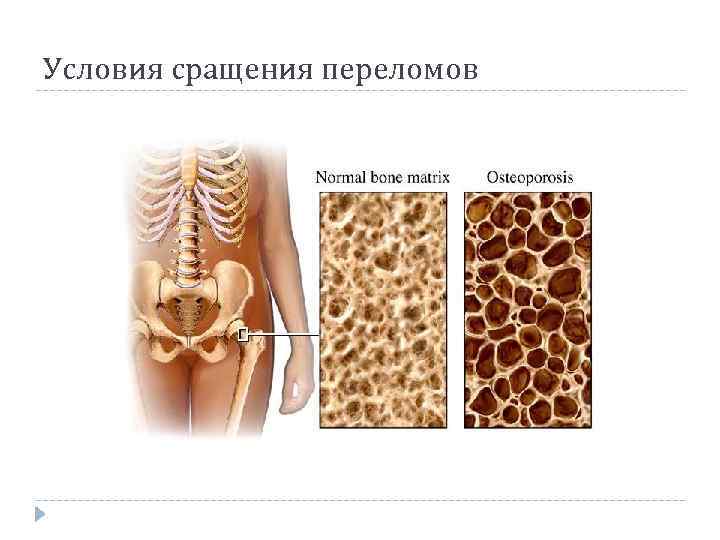 Условия сращения переломов 