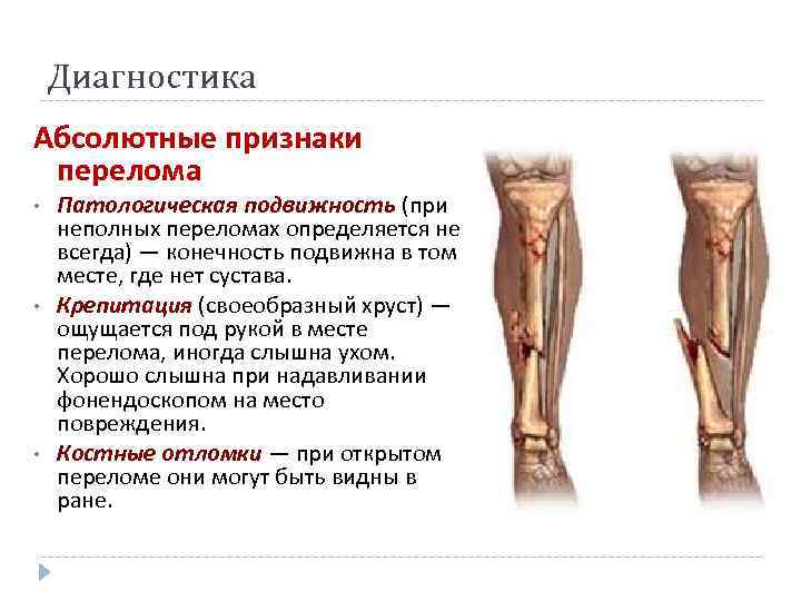 Диагностика Абсолютные признаки перелома • • • Патологическая подвижность (при неполных переломах определяется не