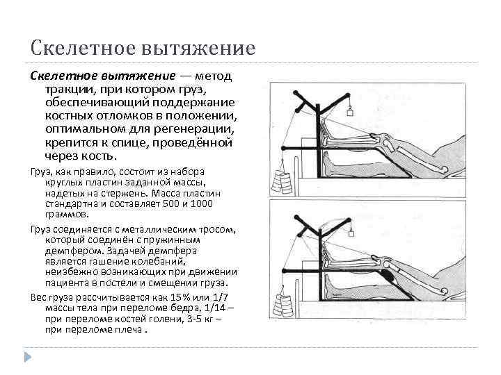 Скелетное вытяжение — метод тракции, при котором груз, обеспечивающий поддержание костных отломков в положении,