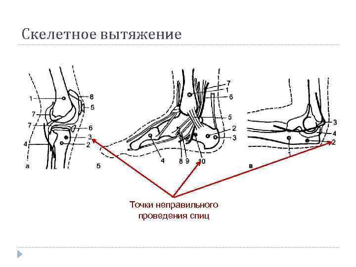 Скелетное вытяжение Точки неправильного проведения спиц 