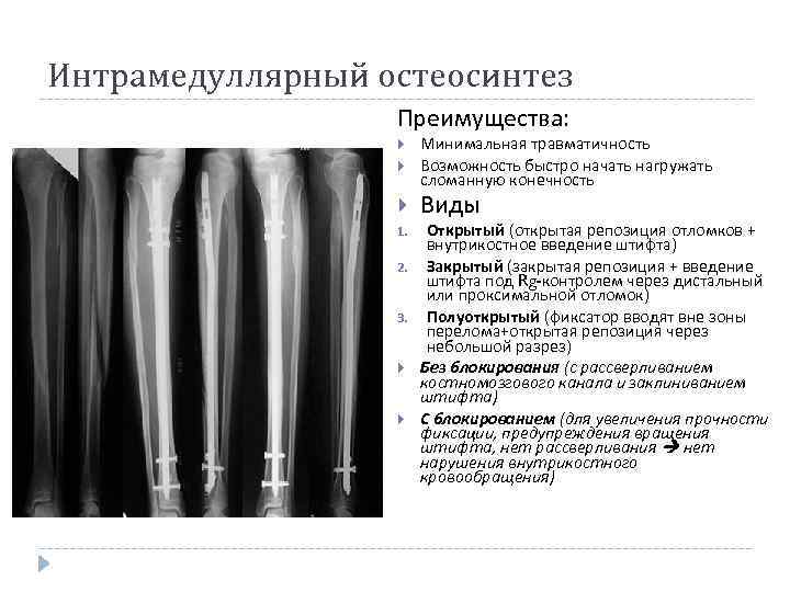 Интрамедуллярный остеосинтез Преимущества: 1. 2. 3. Минимальная травматичность Возможность быстро начать нагружать сломанную конечность