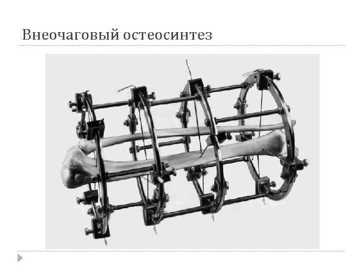 Внеочаговый остеосинтез 