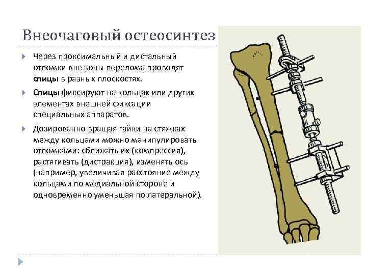 Внеочаговый остеосинтез Через проксимальный и дистальный отломки вне зоны перелома проводят спицы в разных