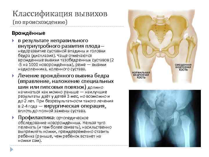 Врожденный вывих коленного сустава