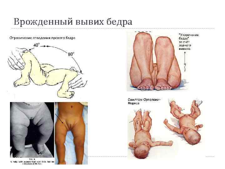 Врожденный вывих бедра 