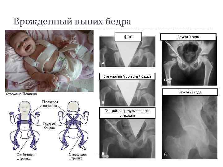 Врожденный вывих бедра фас Спустя 3 года С внутренней ротацией бедра Спустя 23 года