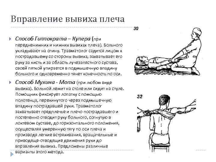 Вправление вывиха плеча Способ Гиппократа – Купера (при передненижних и нижних вывихах плеча). Больного