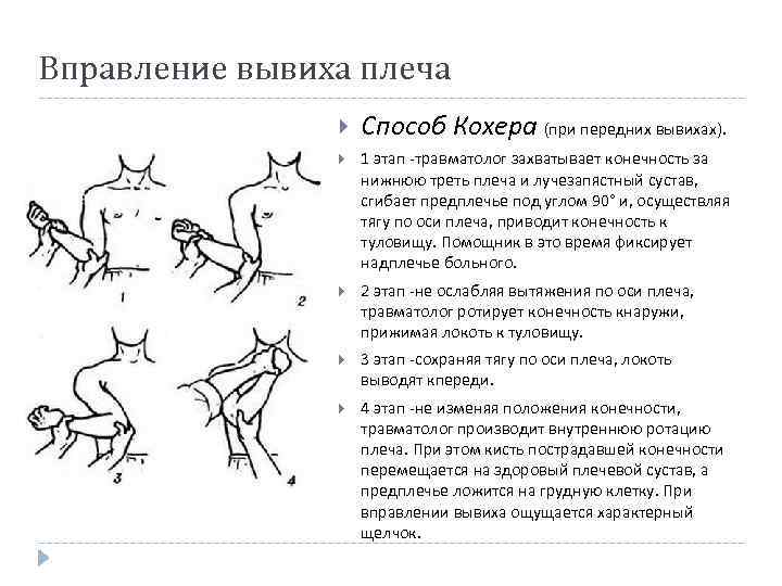 Вправление вывиха плеча Способ Кохера (при передних вывихах). 1 этап травматолог захватывает конечность за