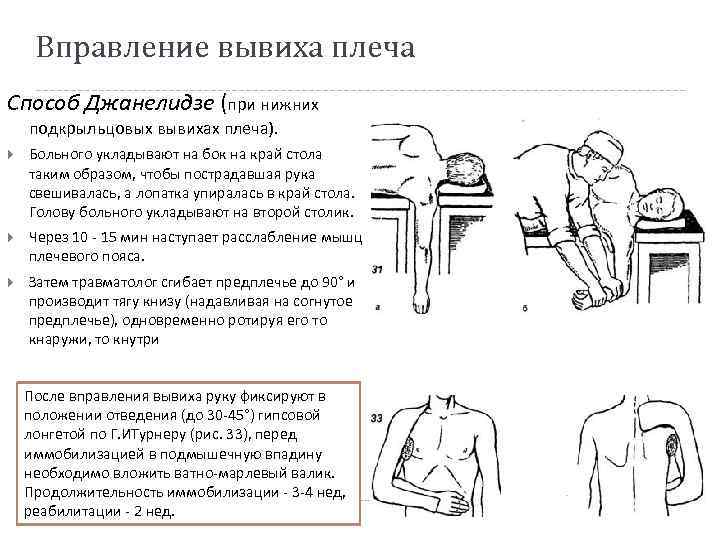 Вправление вывиха плеча Способ Джанелидзе (при нижних подкрыльцовых вывихах плеча). Больного укладывают на бок