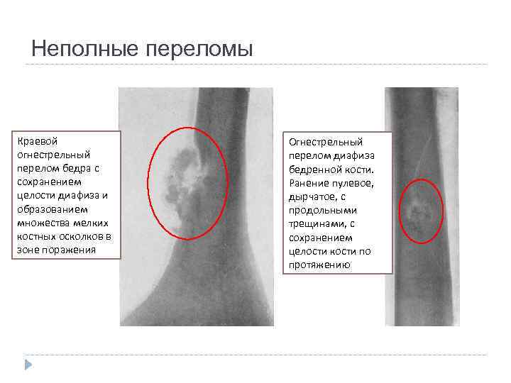 Неполные переломы Краевой огнестрельный перелом бедра с сохранением целости диафиза и образованием множества мелких