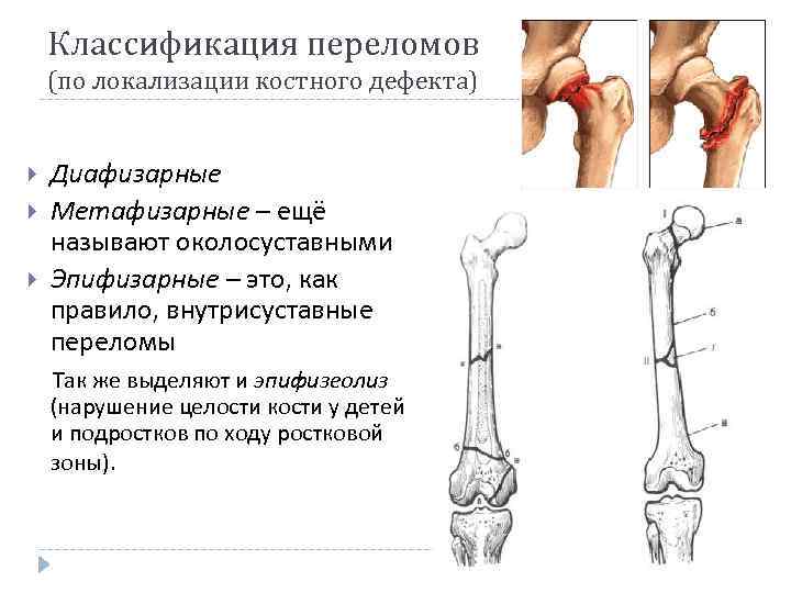 Диафизарный перелом