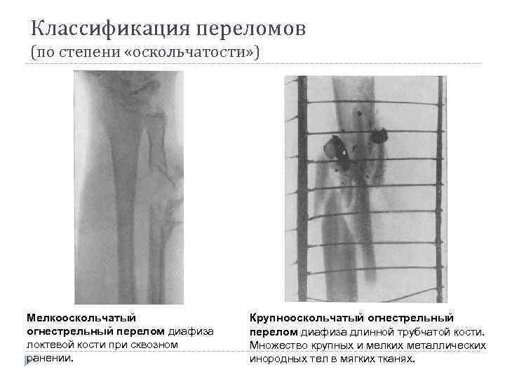 Классификация переломов (по степени «оскольчатости» ) Мелкооскольчатый огнестрельный перелом диафиза локтевой кости при сквозном