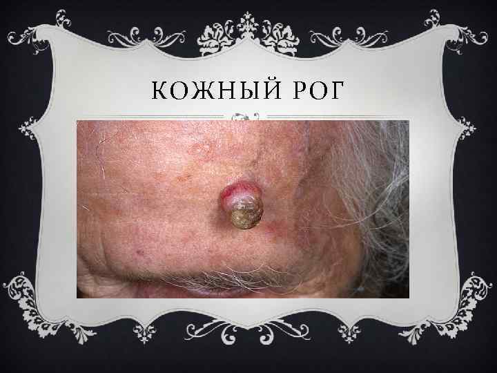 КОЖНЫЙ РОГ 