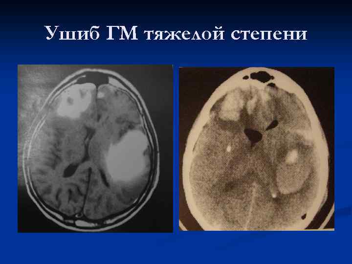 Ушиб ГМ тяжелой степени 