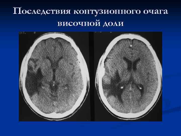 Что значит очаг в головном мозге. Контузионный очаг в головном мозге на кт. Контузионные очаги головного мозга на кт. Контузионные очаги ЧМТ кт. Контузионный очаг 2 типа кт.