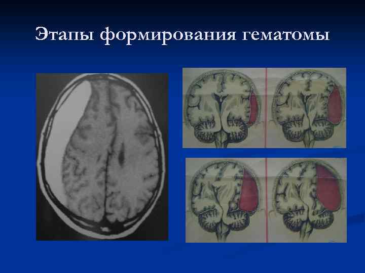 Этапы формирования гематомы 