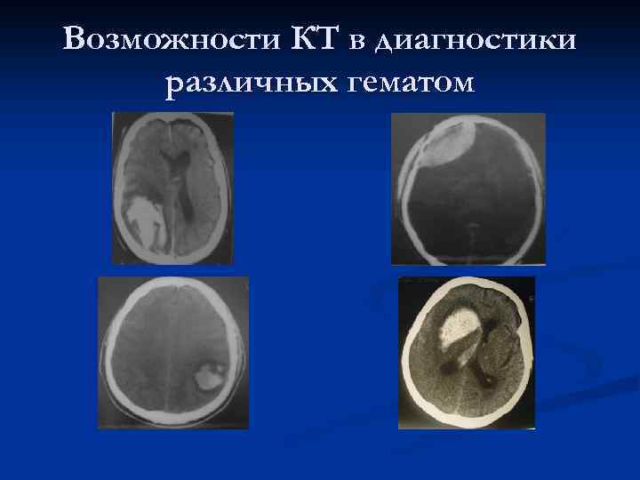 Возможности КТ в диагностики различных гематом 