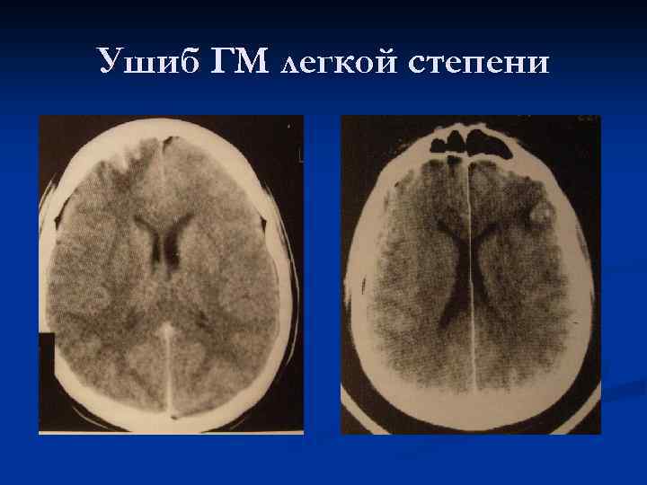 Ушиб ГМ легкой степени 