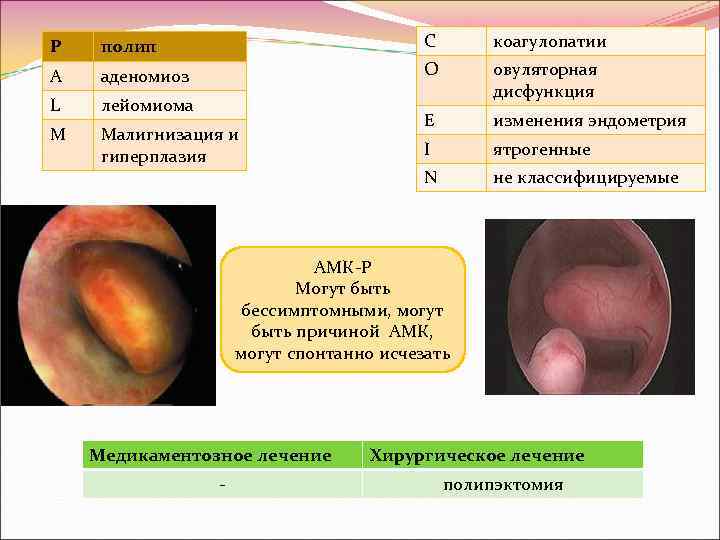 P полип C коагулопатии A аденомиоз O L лейомиома овуляторная дисфункция M Малигнизация и
