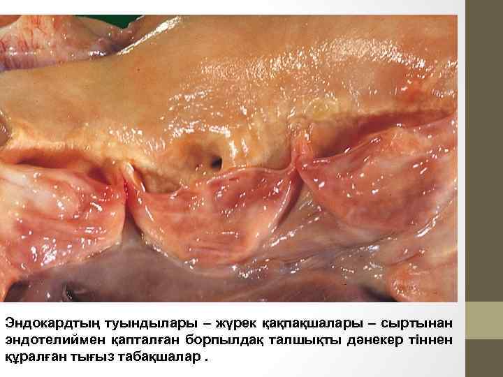 Эндокардтың туындылары – жүрек қақпақшалары – сыртынан эндотелиймен қапталған борпылдақ талшықты дәнекер тіннен құралған
