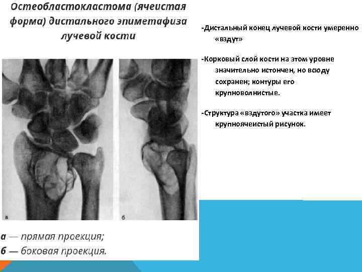 -Дистальный конец лучевой кости умеренно «вздут» -Корковый слой кости на этом уровне значительно истончен,