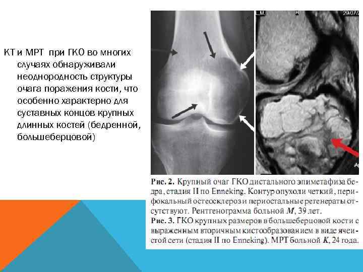 КТ и МРТ при ГКО во многих случаях обнаруживали неоднородность структуры очага поражения кости,