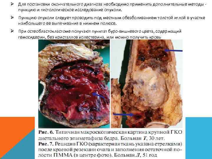 Ø Для постановки окончательного диагноза необходимо применить дополнительные методы пункцию и гистологическое исследование опухоли.