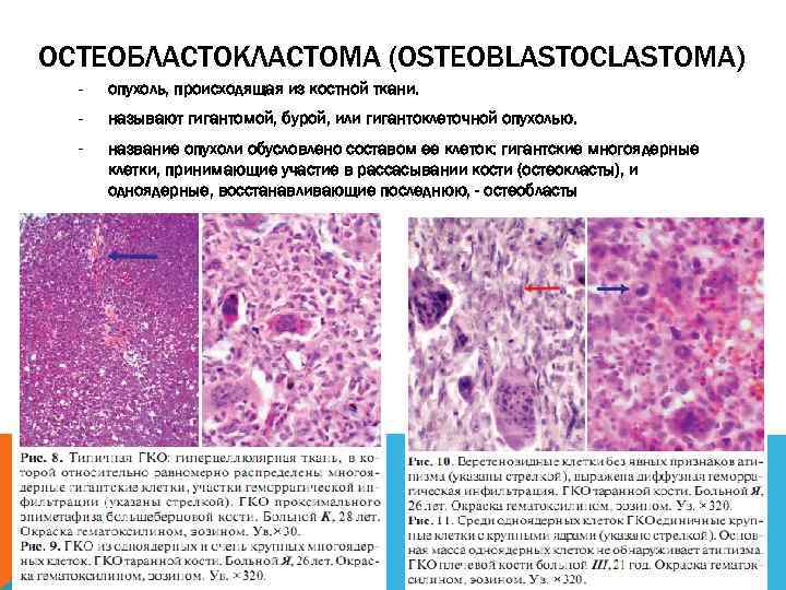 ОСТЕОБЛАСТОКЛАСТОМА (OSTEOBLASTOCLASTOMA) - опухоль, происходящая из костной ткани. - называют гигантомой, бурой, или гигантоклеточной