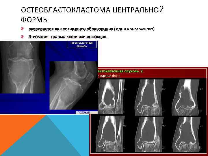 ОСТЕОБЛАСТОКЛАСТОМА ЦЕНТРАЛЬНОЙ ФОРМЫ развивается как солитарное образование (один конгломерат) Этиология- травма кости или инфекция.
