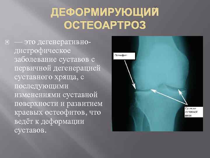 ДЕФОРМИРУЮЩИЙ ОСТЕОАРТРОЗ — это дегенеративнодистрофическое заболевание суставов с первичной дегенерацией суставного хряща, с последующими