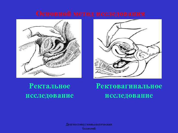 Основной метод исследования Ректальное исследование Ректовагинальное исследование Диагностика гинекологических болезней 