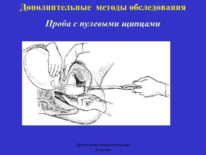 Дополнительные методы обследования Проба с пулевыми щипцами Диагностика гинекологических болезней 