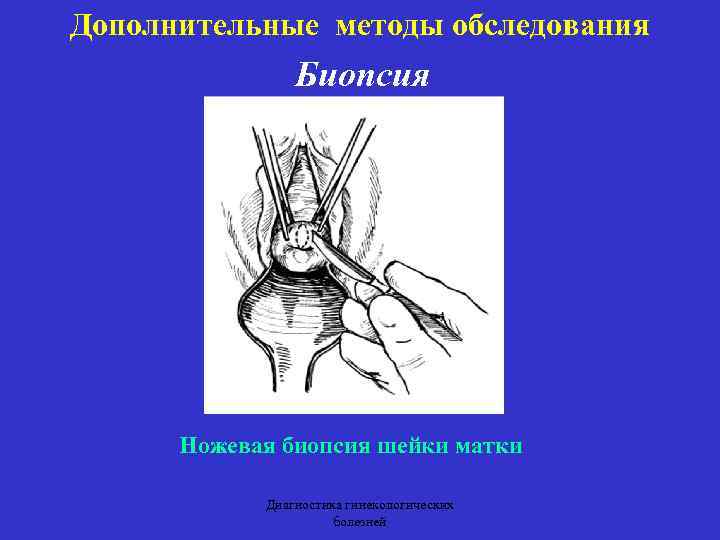 Сделать конизацию. Методы биопсии в акушерстве. Биопсия шейки матки методика.