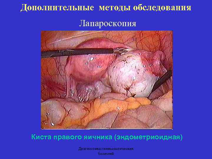 Дополнительные методы обследования Лапароскопия Киста правого яичника (эндометриоидная) Диагностика гинекологических болезней 