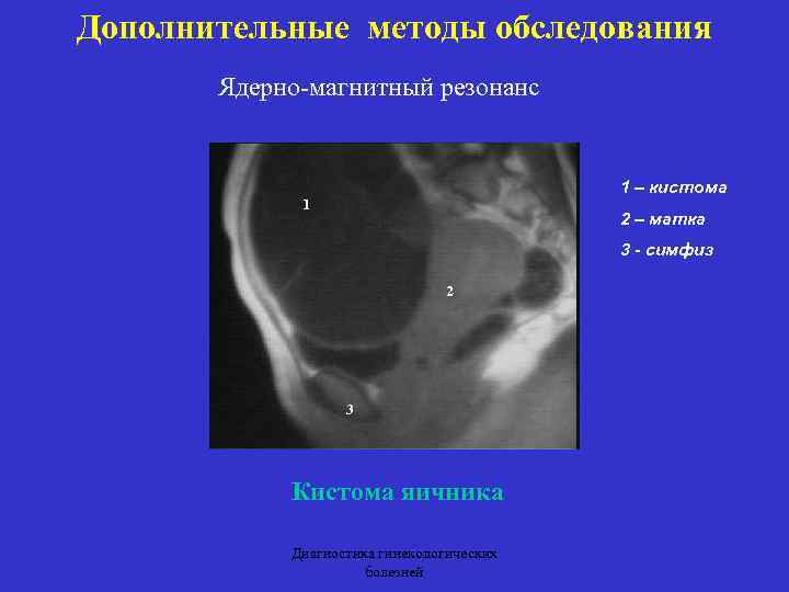Дополнительные методы обследования Ядерно-магнитный резонанс 1 – кистома 1 2 – матка 3 -