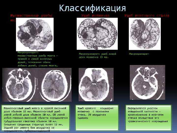 Множественные ушибы мозга Классификация Макропрепарат: множественные ушибы мозга – правой и левой височных долей,