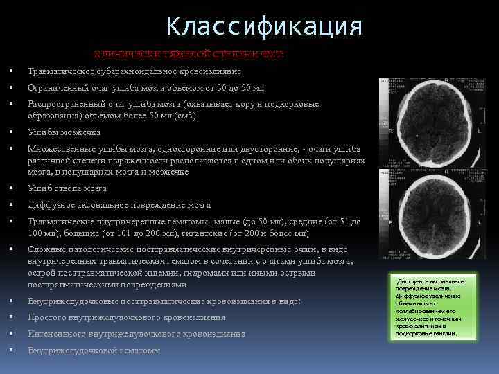 Классификация КЛИНИЧЕСКИ ТЯЖЕЛОЙ СТЕПЕНИ ЧМТ: Травматическое субарахноидальное кровоизлияние Ограниченный очаг ушиба мозга объемом от