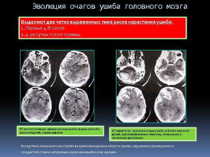 Очаги в головном мозге. Очаги ушиба головного мозга на кт. Контузионные очаги головного мозга 2 типа. Контузионные очаги головного мозга на кт. Контузионный очаг 2 типа кт.