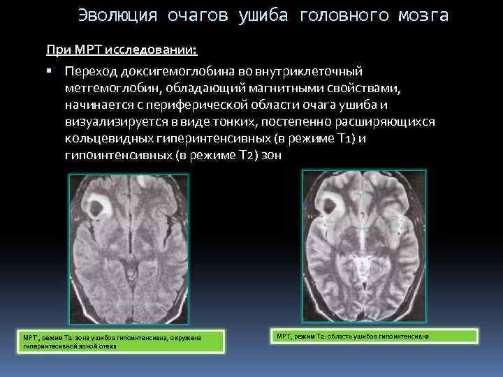 Эволюция очагов ушиба головного мозга При МРТ исследовании: Переход доксигемоглобина во внутриклеточный метгемоглобин, обладающий